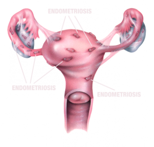 endometriosis_01_fb5b9e5899673c91092dbf3ff231f3e5